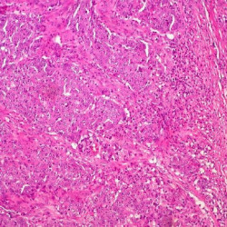 Desarrollan un virus que mata el c&aacute;ncer de colon activando el sistema inmunol&oacute;gico