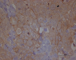 Descubren una caracter&iacute;stica clave que permite que las c&eacute;lulas cancerosas migren y generen met&aacute;stasis