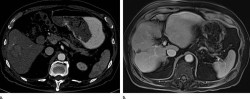 El avance de un f&aacute;rmaco brinda la supervivencia m&aacute;s prolongada en pacientes con c&aacute;ncer de h&iacute;gado no resecable