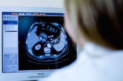 Identifican una nueva diana farmacol&oacute;gica para tratar el c&aacute;ncer de pr&oacute;stata agresivo