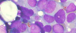 La gen&eacute;tica ya no es fundamental en la aparici&oacute;n del c&aacute;ncer 