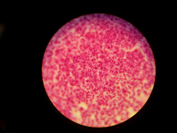  Las infecciones de transmisi&oacute;n sexual aumentan 