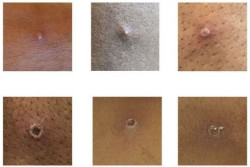 Sanidad confirma 186 casos positivos de viruela del mono en Espa&ntilde;a