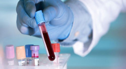 Un an&aacute;lisis de sangre podr&iacute;a reemplazar la cirug&iacute;a para algunos pacientes con tumores cerebrales
