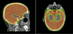Un estudio cambia el abordaje del tratamiento de la met&aacute;stasis cerebral en c&aacute;ncer de pulm&oacute;n