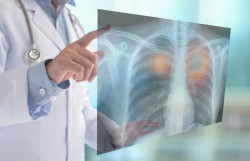 Un estudio en ratones muestra que una terapia combinada detiene la progresi&oacute;n de c&aacute;ncer de pulm&oacute;n de c&eacute;lulas peque&ntilde;as