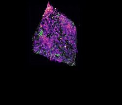Un estudio muestra c&oacute;mo algunos c&aacute;nceres pueden desactivar el sistema inmune y crecer sin control