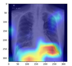 Valdecilla acoge el lunes una jornada sobre salud hep&aacute;tica y metab&oacute;lica